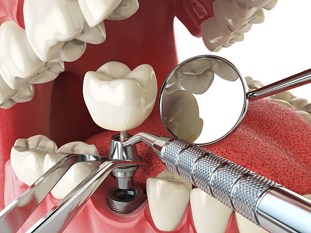 Best Broken or Chipped Tooth Repair in Winfield, MO